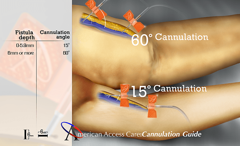 Cannulation Angle Guide