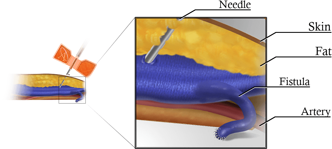 Cannulation angle inset detail 1