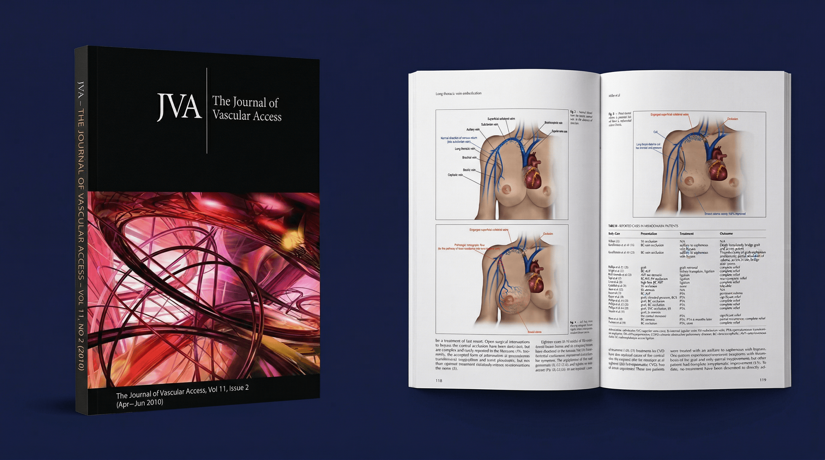 Journal of Vascular Access Vol 11, breast edema publication