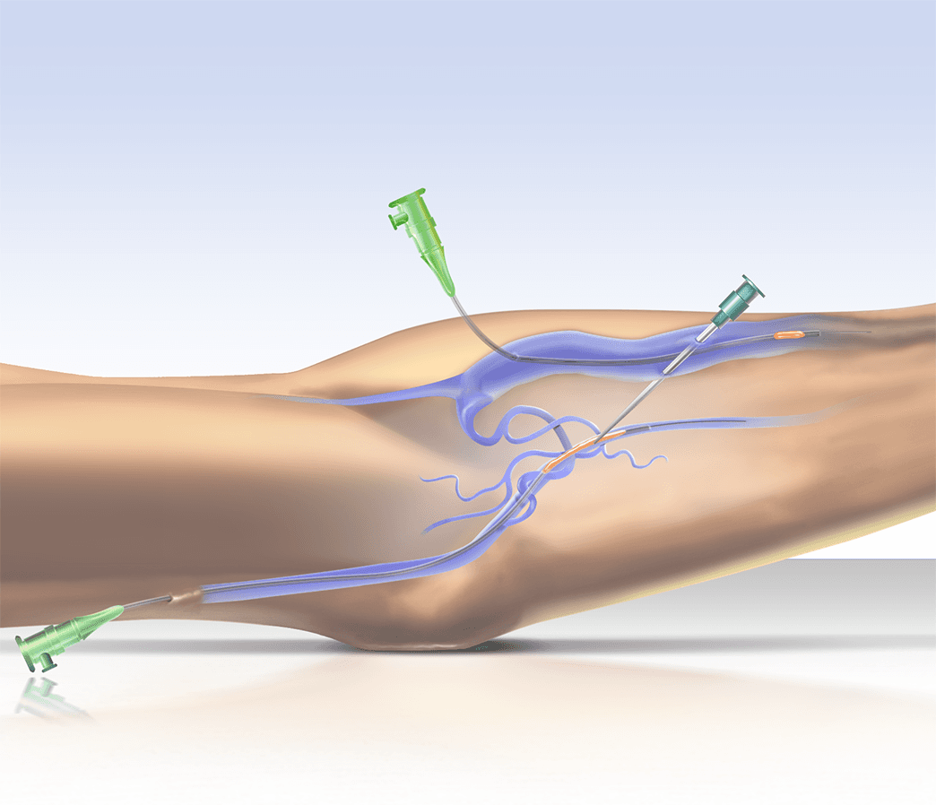 Sharp Needle Recanalization