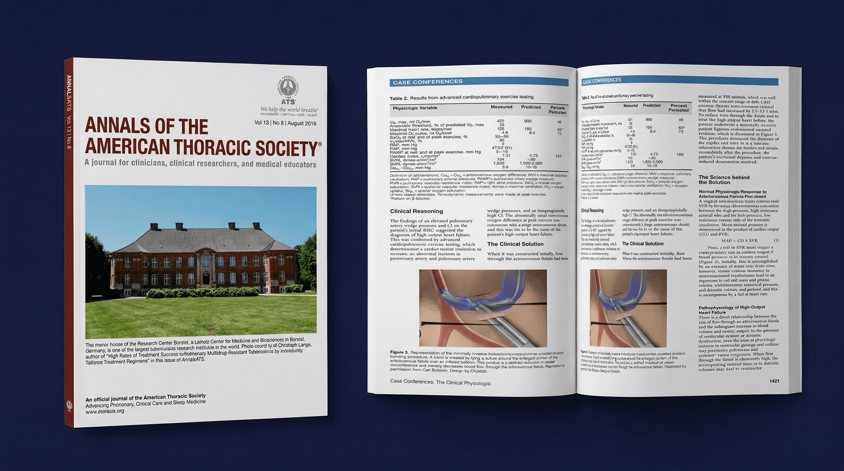 Annals of the American Thoracic Society, dyspnea and AVF publication