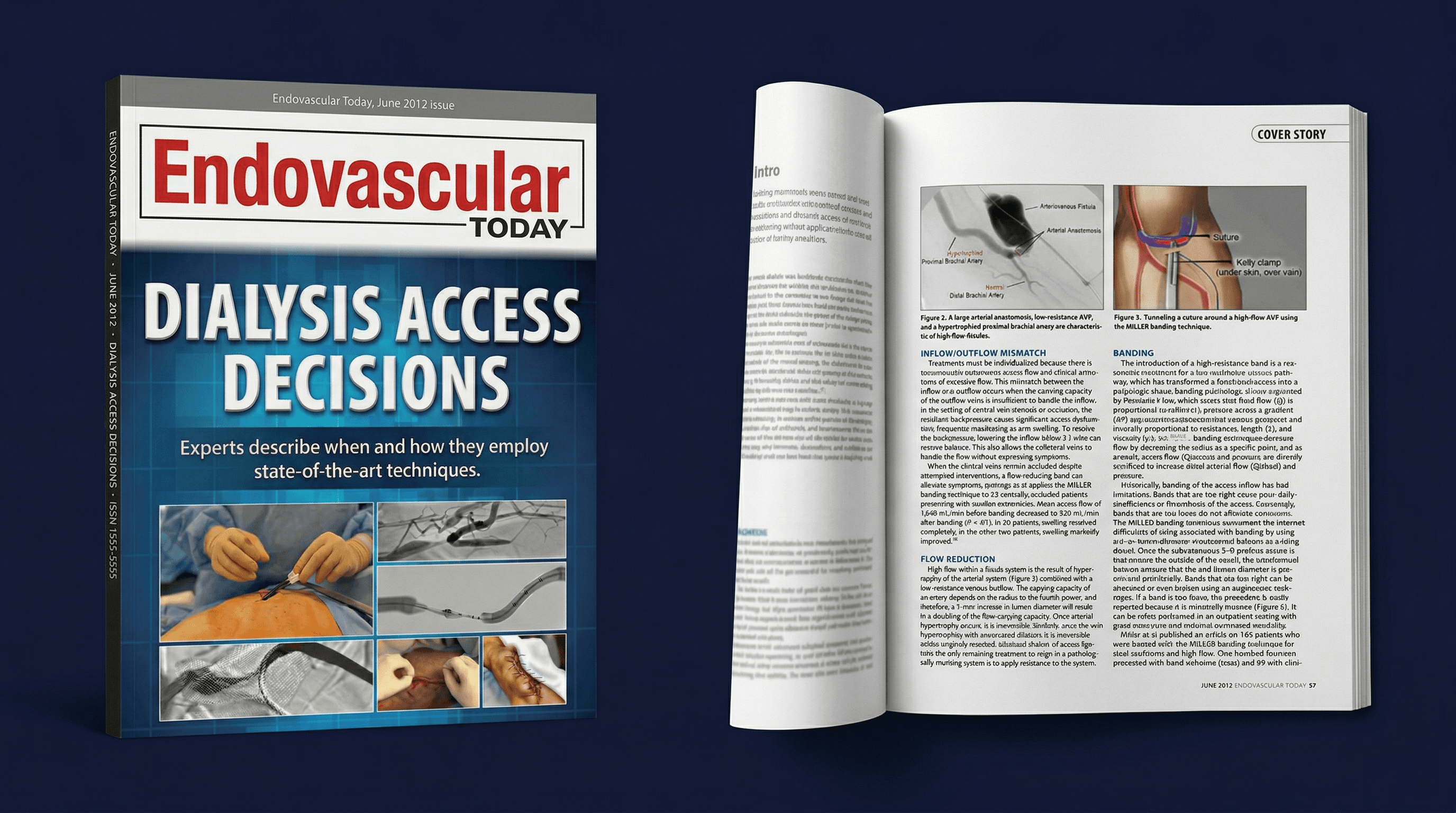 Endovascular Today, high-flow AVFs publication
