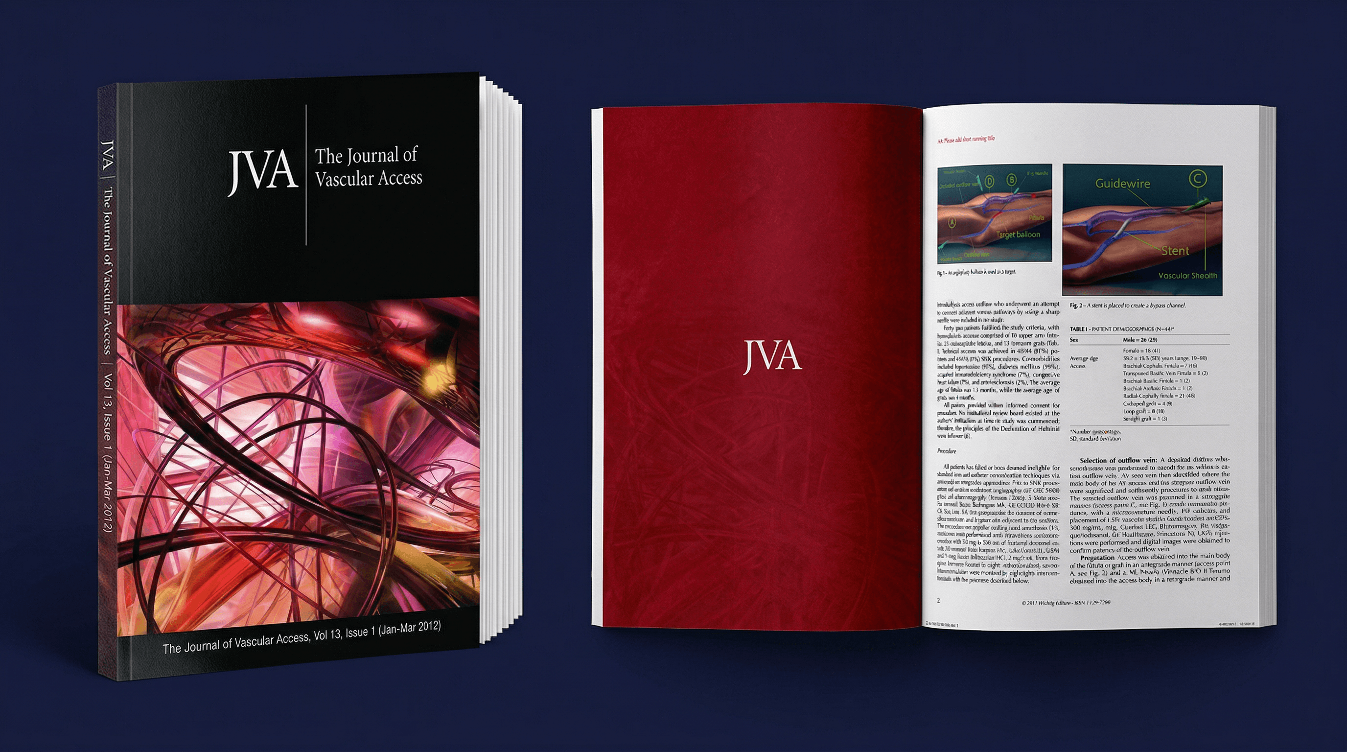 Journal of Vascular Access Vol 13, sharp needle recanalization publication