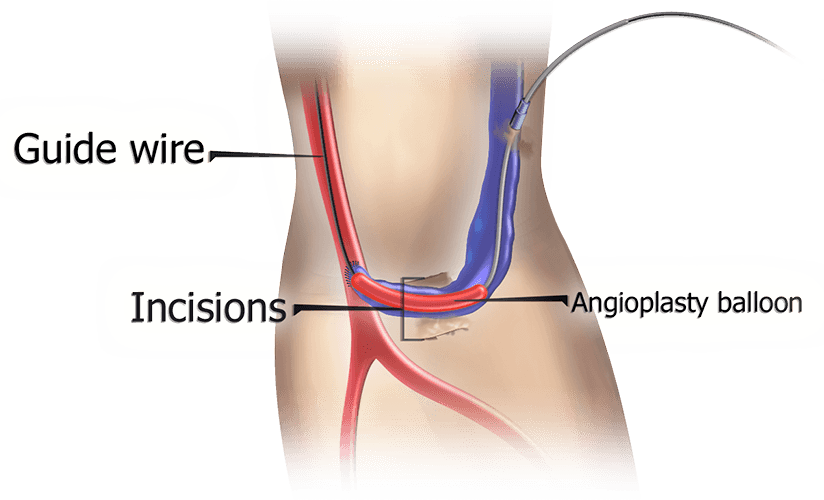 MILLER Banding Procedure anatomical visualization inset 2