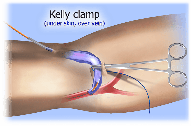 MILLER Banding Procedure anatomical visualization inset 3