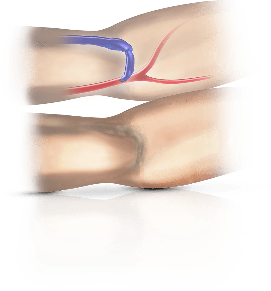 MILLER Banding Procedure anatomical visualization inset 4